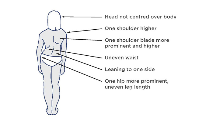 How to tell if your child has scoliosis. Look for symptoms like their head not being centred over the body, one shoulder higher than the other, leaning to one side and one hip appearing more prominent than the other.