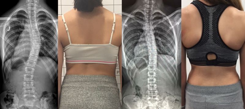 Above: some examples of successful LOC non-surgical treatment for scoliosis.