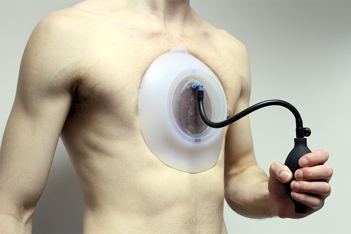 Patient wearing the silicone vacuum bell suction cup over their chest, holding the hand pump