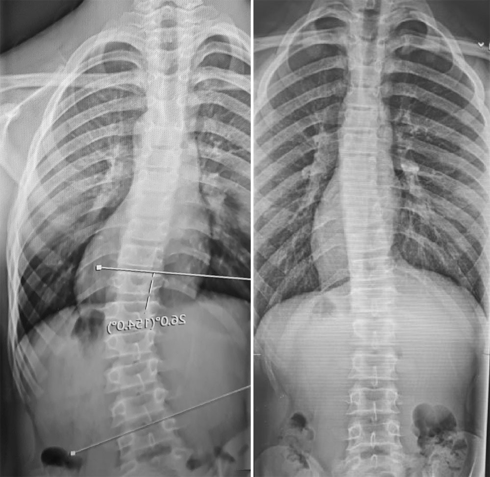 X-ray of scoliosis bracing correction in 15 year old male, before and after 10 months wearing the LOC scoliosis brace