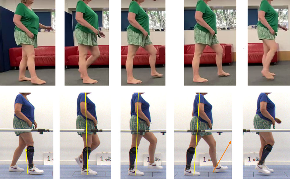 Gait pattern in a stroke patient before and after a neuro swing ankle foot orthosis is fitted