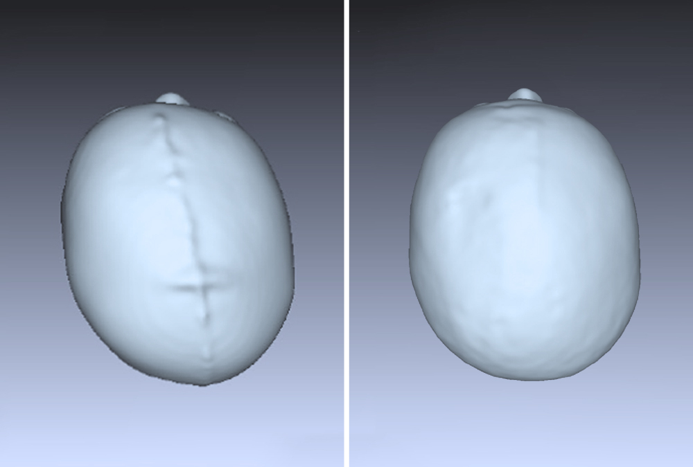 Billy's head shape before plagiocephaly treatment with an asymmetry value of 20mm, and after with a value of 7mm