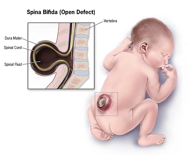 Diagram showing the appearance of spina bifida in a baby's spine