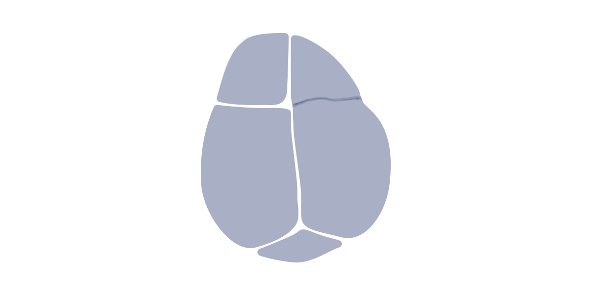Uni coronal synostosis causes asymmetry of the skull base and face, with a displacement of the ears and lateral deviation of the nose away from the side of the frontal flattening.