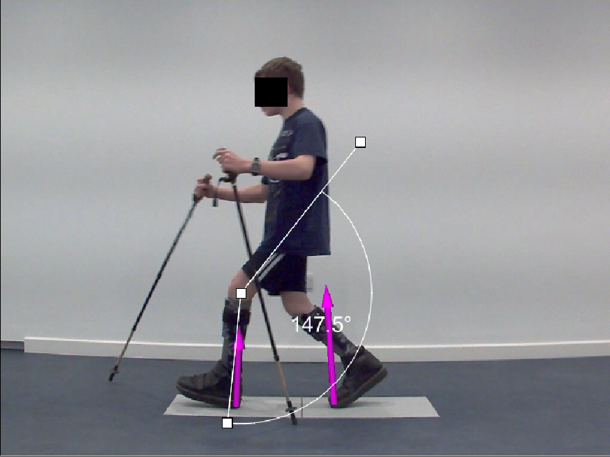 Gait analysis technology used during clinical paediatric orthotic assessment. Shows patient walking with video vectors highlighting the angles created in his walking pattern.