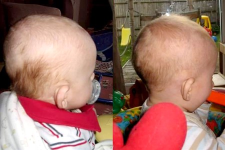 Above:  Ewan before and during LOCband treatment