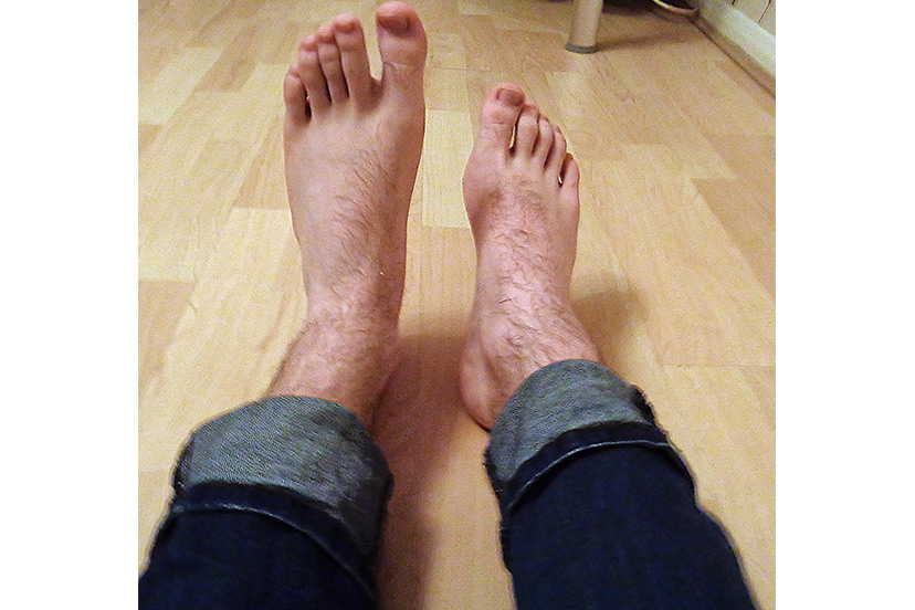 Above: Photo of a man with normal foot (left) and drop foot (right) caused by damage to the anterior tibial muscle nerve, which runs down the side of the lower leg.