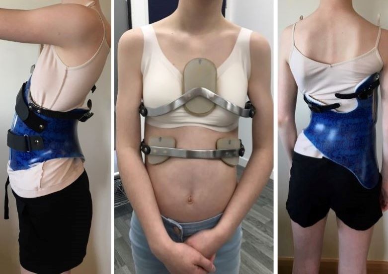 Above left: Daisy in her Gensingen Brace by Dr Weiss. Middle: Daisy in her Pectus Carinatum brace. Right: Daisy’s scoliosis brace from behind