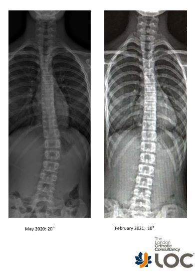 Above: Daisy’s scans in May 2020 and February 2021 show just how effective her bracing solution has been in correcting her scoliosis.
