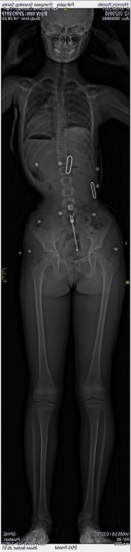 Above: This scan shows Yasmin's position whilst wearing her brace