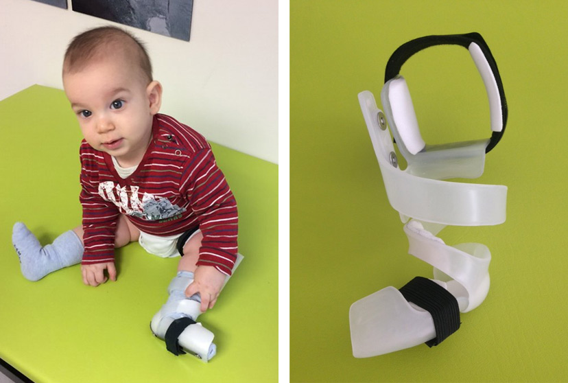 Above: Child wearing Cunningham brace - Image courtesy of Cunningham Prosthetic Care