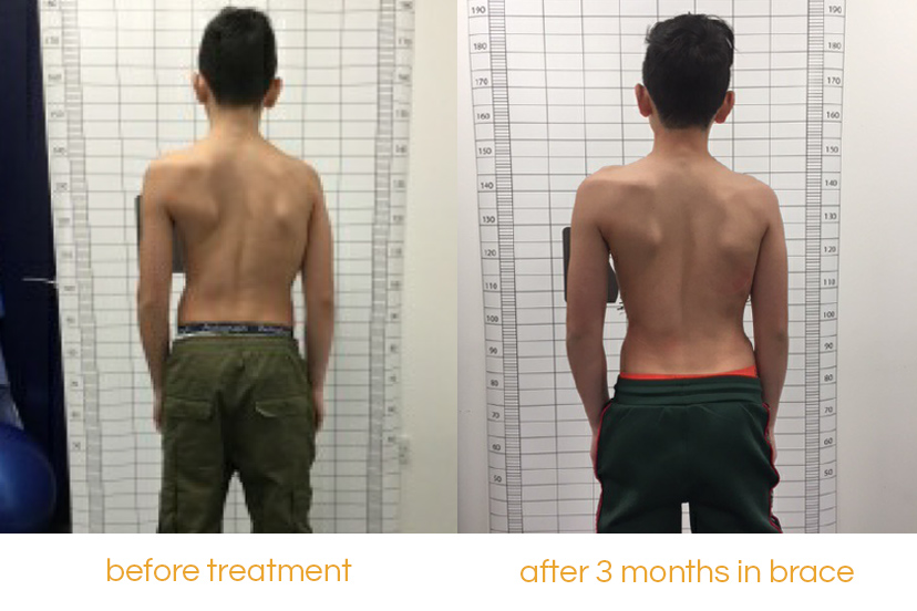Above: Read about twelve-year-old patient Rares' scoliosis journey and his experience with bracing