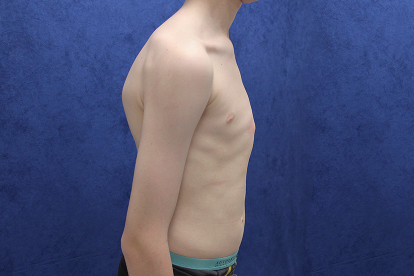 Above: Profile view of chest before bracing treatment