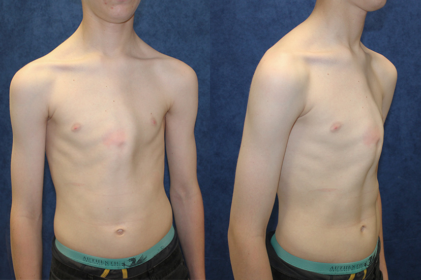 Patient B first came into see us at the age of 14 with an evident case of p...