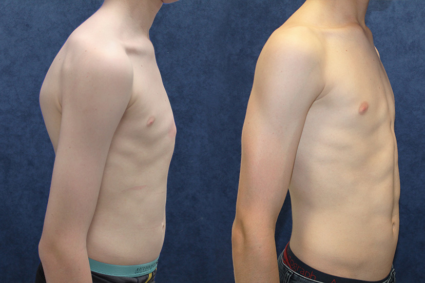Above: Before and after pectus carinatum treatment.