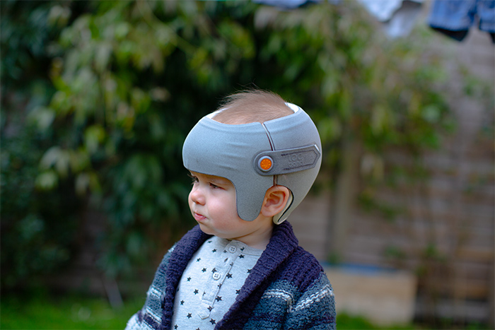 Above: Jack wearing his new 3D printed LOCband-Lite