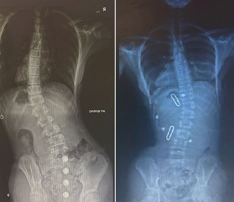 Example 1: Over correction of a curve in a LOC Scoliosis Brace. This patient was then able to reduce the hours of brace wear.