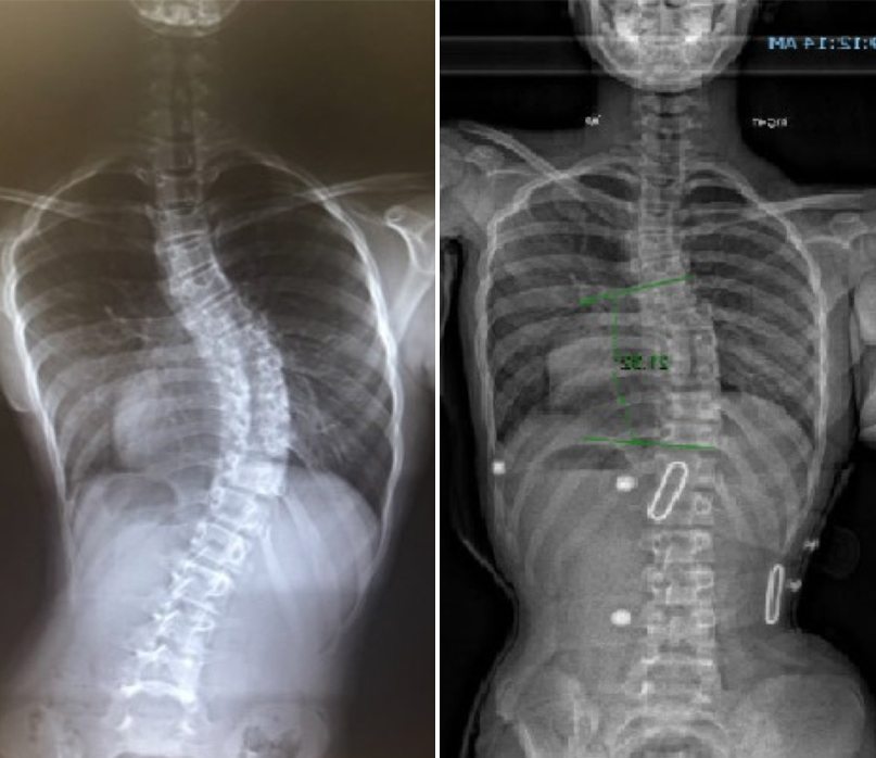 Before treatment (left), after LOC Scoliosis Brace treatment (right)