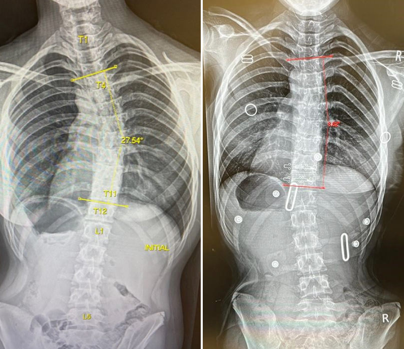 Example 3: Excellent in-brace correction in a LOC Scoliosis Brace.