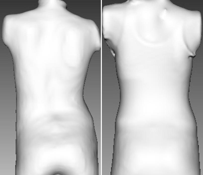 Example 1: Waistline and pelvic correction in an adolescent after only 4 weeks of wearing a LOC Scoliosis Brace. This will continue to improve throughout treatment.