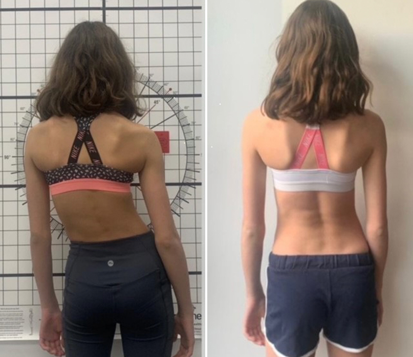 Adolescent scoliosis patient showing spinal curve before and after bracing treatment at the London Orthotic Consultancy