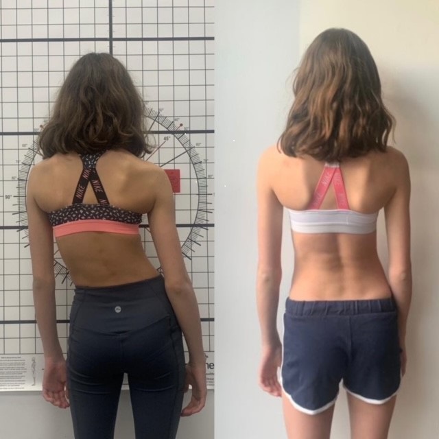 postural change before (left) and after LOC Scoliosis Brace treatment (right)