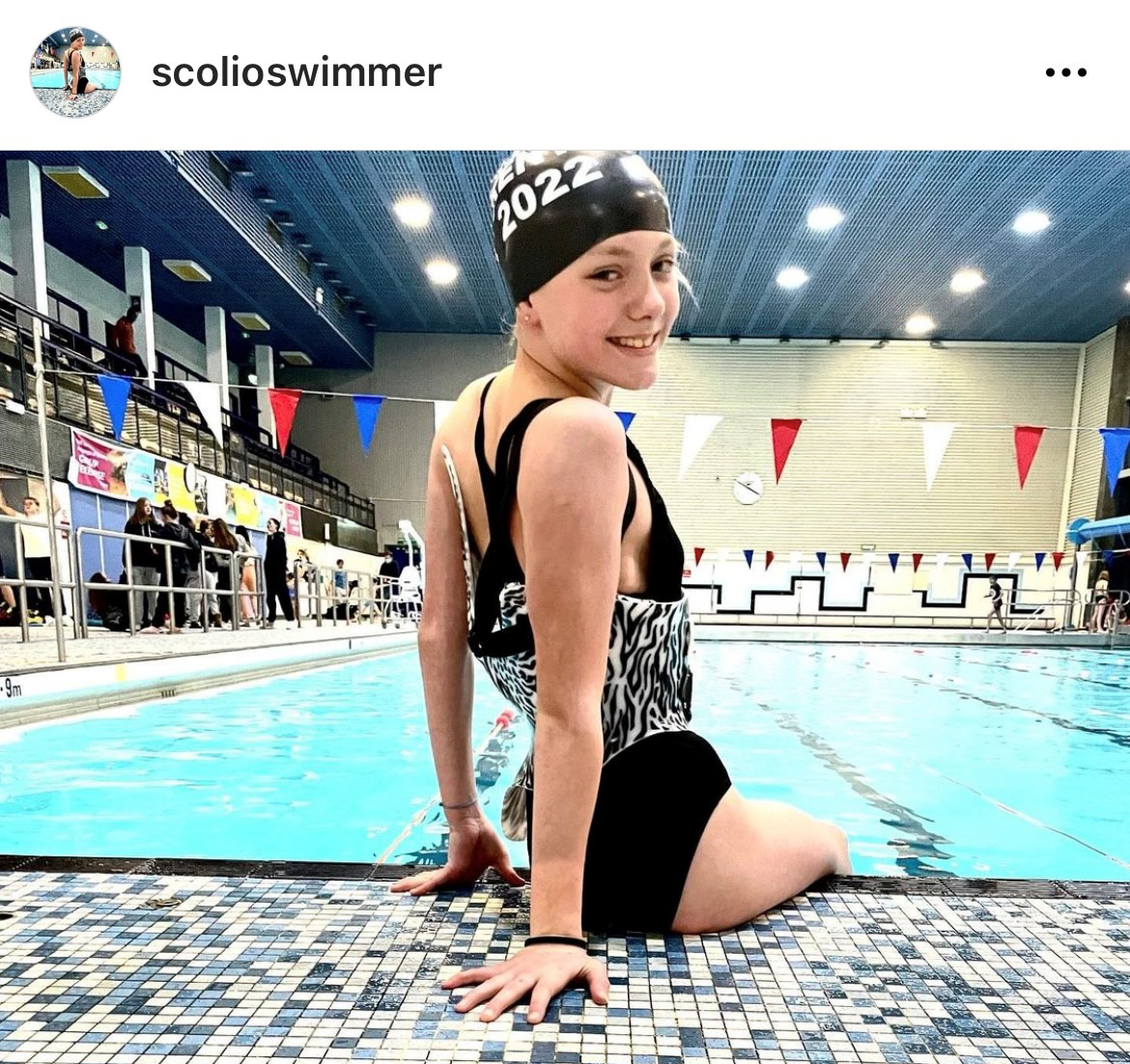Sophie at the swimming pool in her LOC Scoliosis Brace