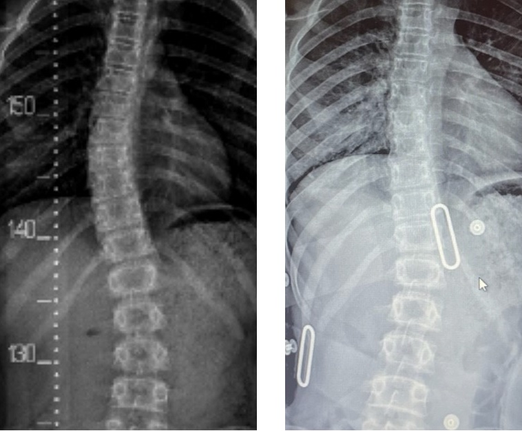 (image left) Pre treatment - Right dominant thoracic scoliosis measuring 26 degrees, (image right) In LOC Scoliosis Brace at first review curve, corrected to <10 degrees