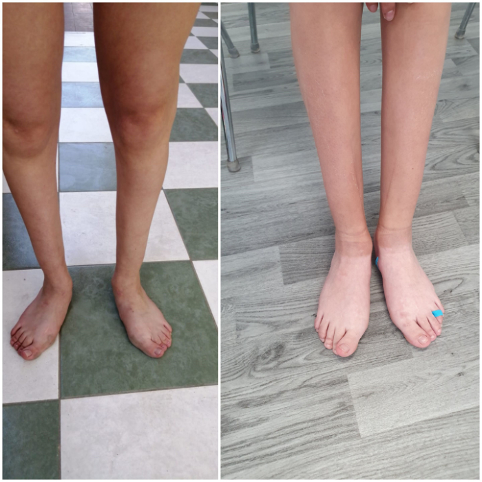 Before (left) After treatment (right)