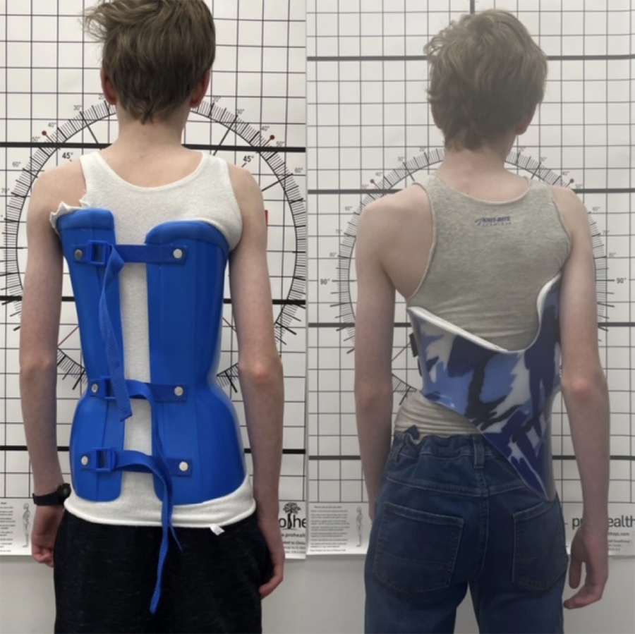 Left: The Boston Brace, which has to be tied from behind. Right: LOC’s Scoliosis Brace, which ties from the side so patient can do by themselves
