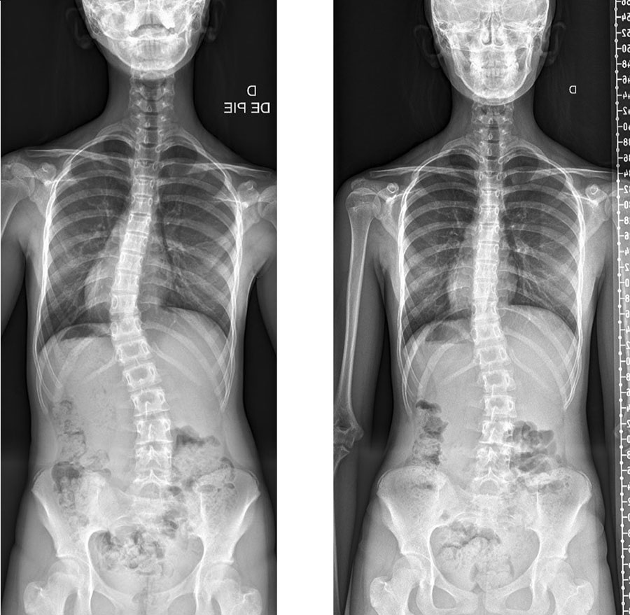 Scoliosis X-ray before and after scoliosis bracing treatment