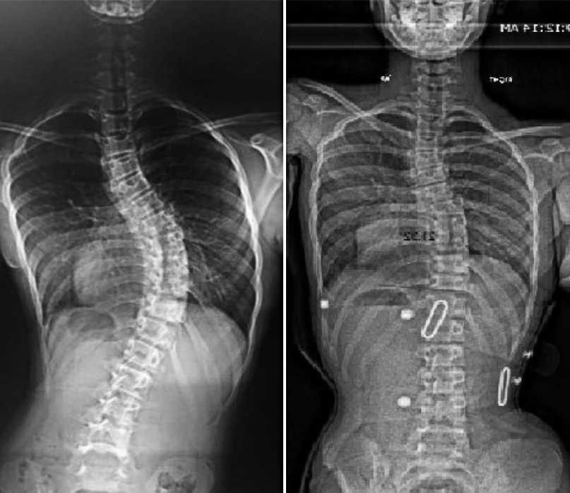 Before and After spinal x-rays of a London Orthotic Consultancy patient with 80% in-brace skeletal correction.