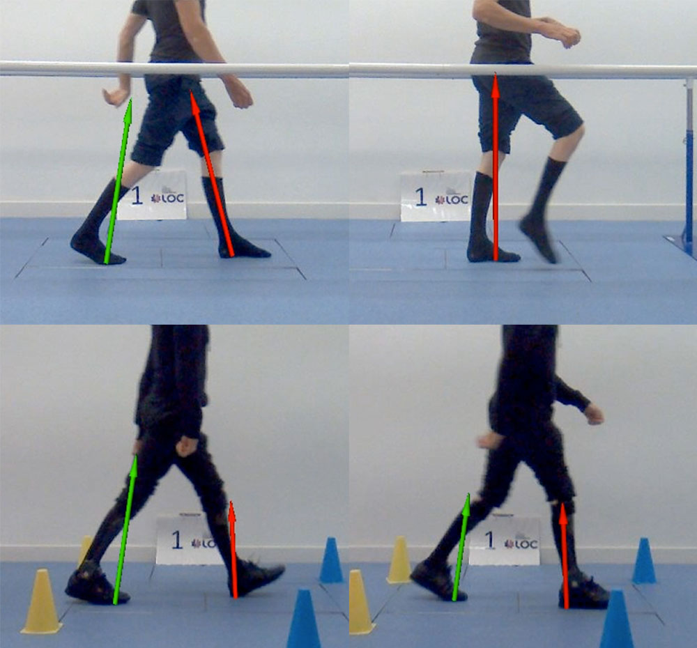 Top: Charcot-Marie-Tooth patient walks in the gait lab barefoot. Bottom: Walking pattern after AFOs have been fitted.