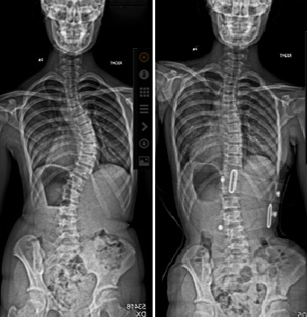Scoliosis X-ray before and after wearing the LOC Scoliosis Brace. 14 year old with 54 degree Cobb angle prior to treatment. In brace scan after 5 weeks curve reduced to 14 degrees