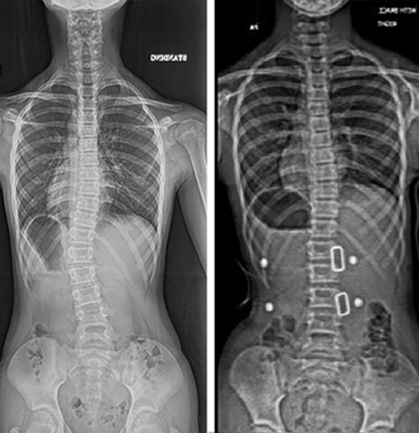 Before and after scoliosis x-rays showing the curvature of the spine reducing from 26 degrees to 6 degrees after wearing a London Orthotic Consultancy brace.