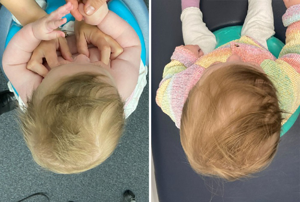 Overhead view of baby's head shape before and after plagiocephaly treatment with the LOCBand Lite helmet