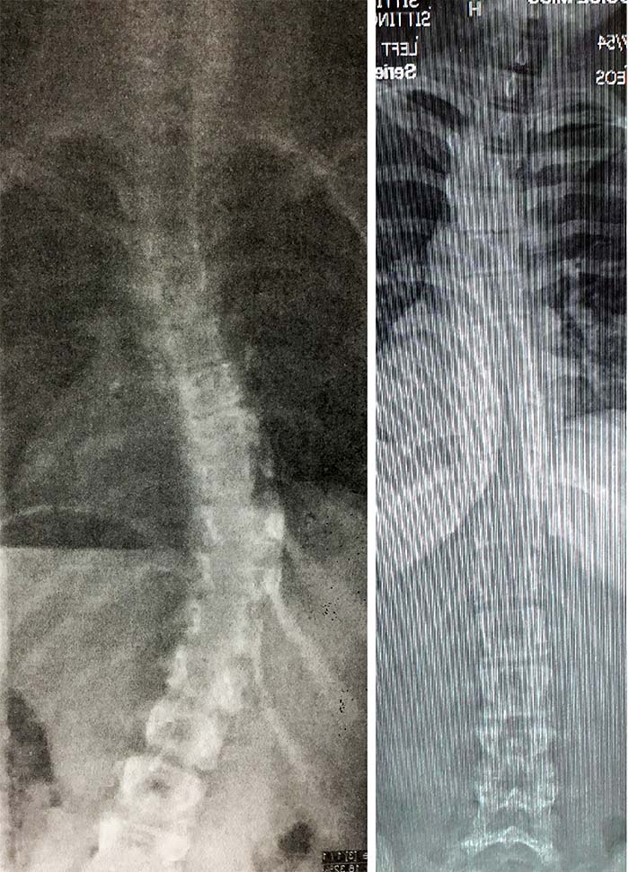 Before and after X-ray results wearing London Orthotic Consultancy's scoliosis brace. The patient's scoliosis curve has gone down from 42 degrees to 5 degrees.
