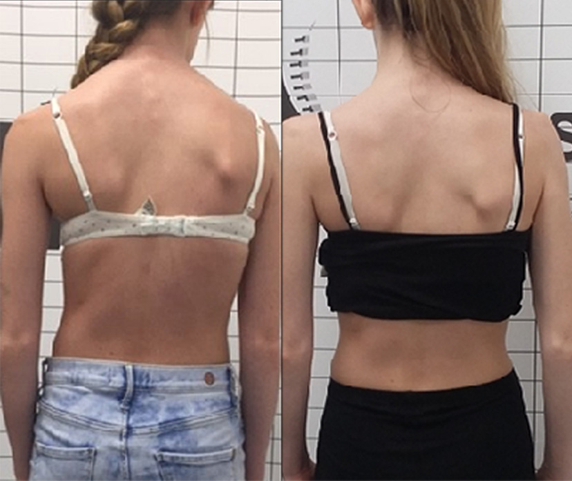 Female adolescent scoliosis patient before and after bracing treatment showing an improvement in posture and a reduction in the spinal curve