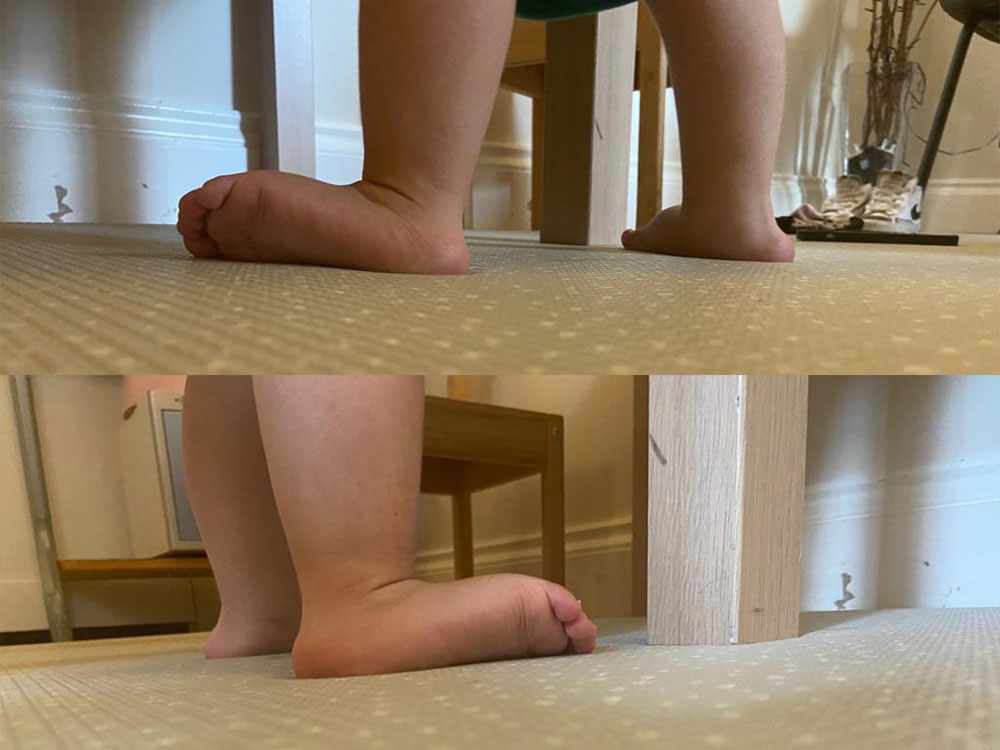 Gus's hypermobility meant the soles of his feet pointed outward when standing.