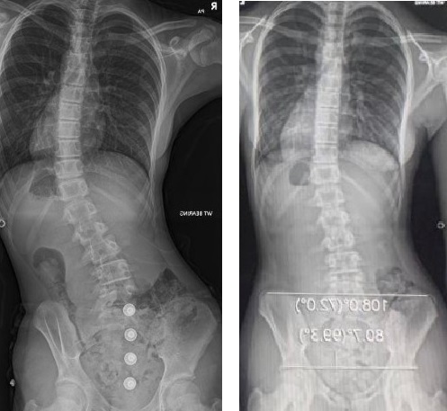 Before and after X-rays of adolescent idiopathic scoliosis patient during treatment at the London Orthotic Consultancy