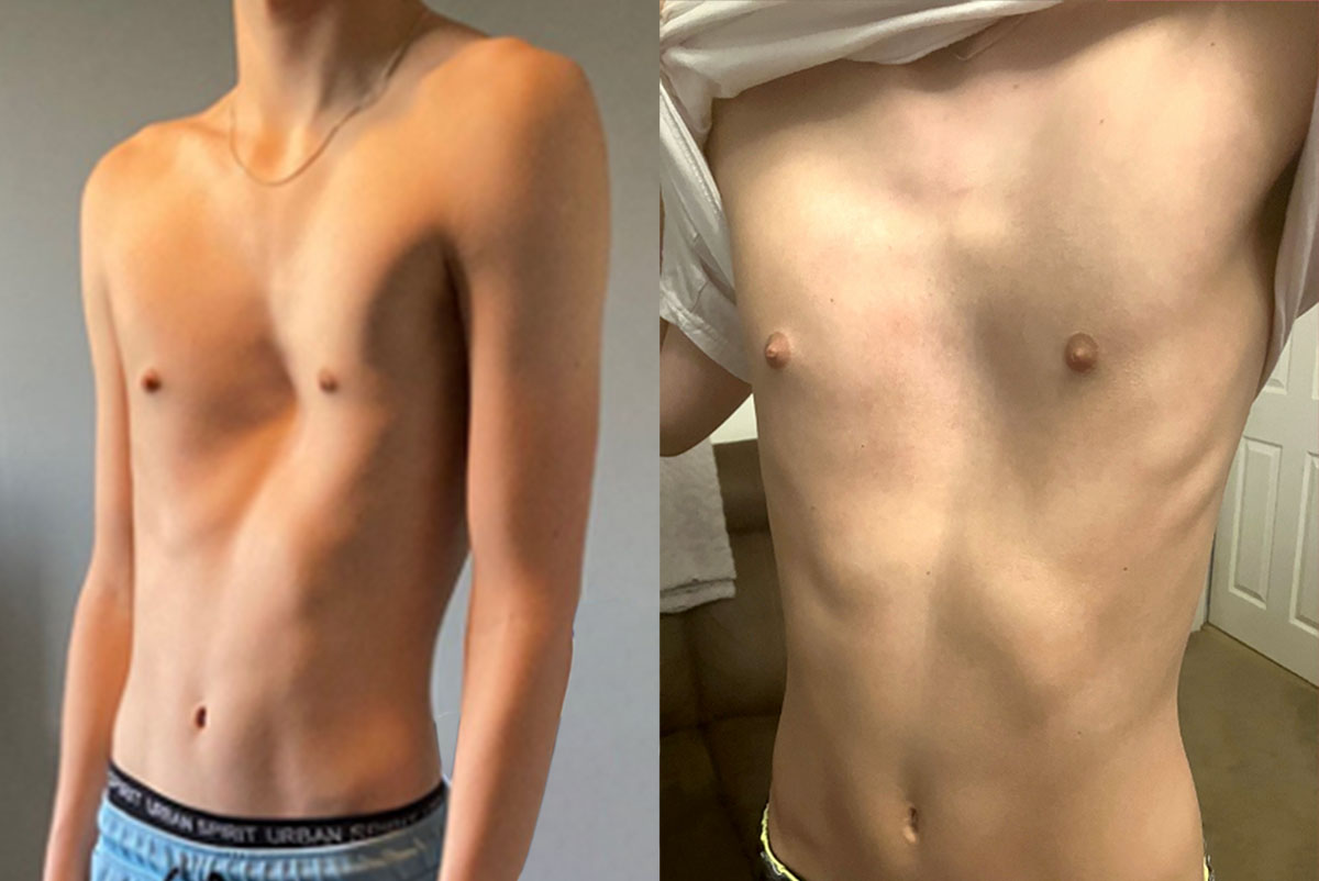 Pectus excavatum patient before treatment and after 6 months of vacuum bell therapy treatment at the London Orthotic Consultancy