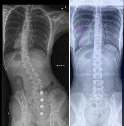 Teenage scoliosis patient before treatment and after 16 months of wearing the London Orthotics scoliosis brace has reduced their spinal curve to zero degrees