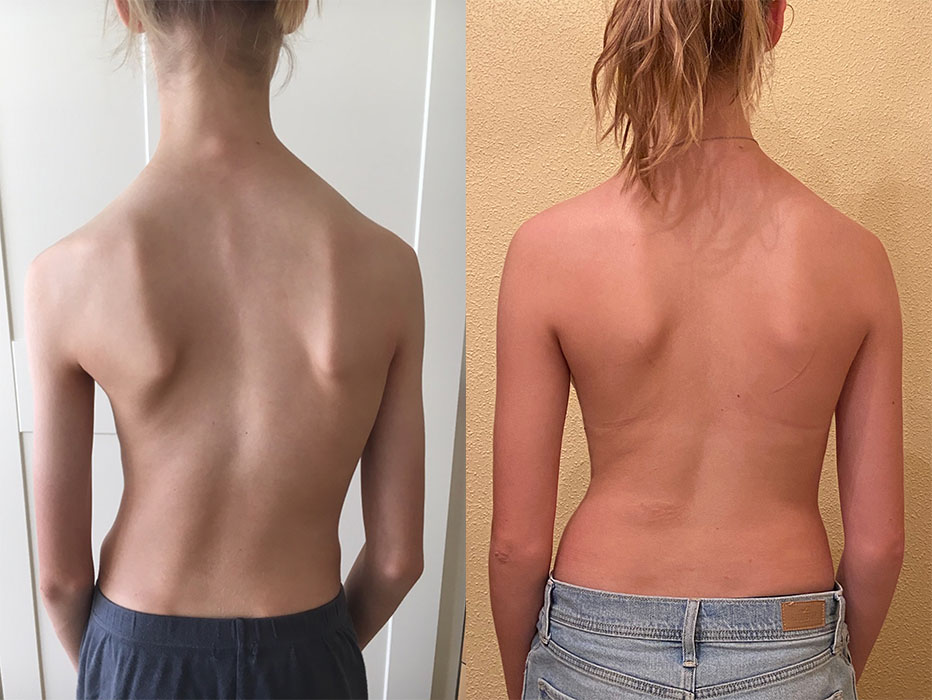 Teenage scoliosis patient who avoided surgery thanks to the LOC scoliosis brace