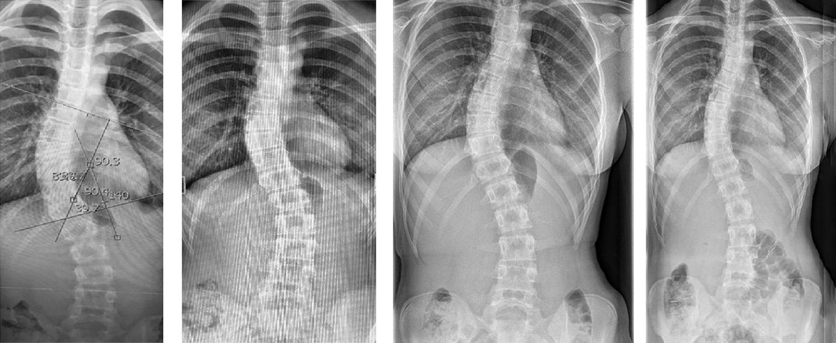 X-rays showing an adolescent scoliosis curve improving with time after wearing the London Orthotic Consultancy Scoliosis brace, causing the spine to straighten