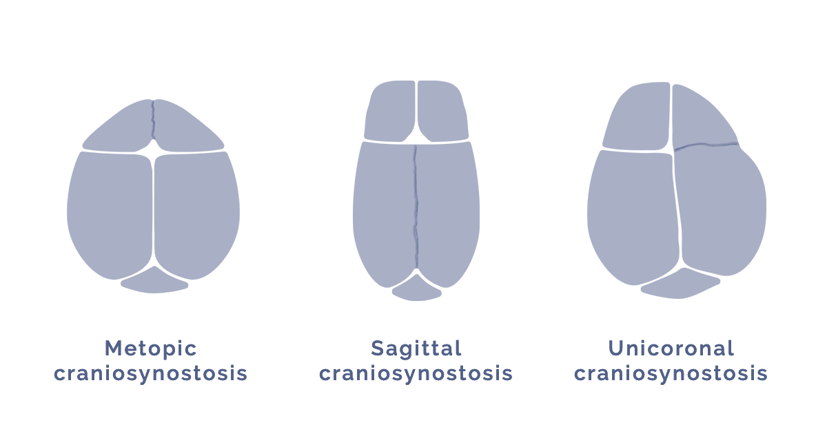 Different types of craniosynostosis, metopic, sagittal, coronal