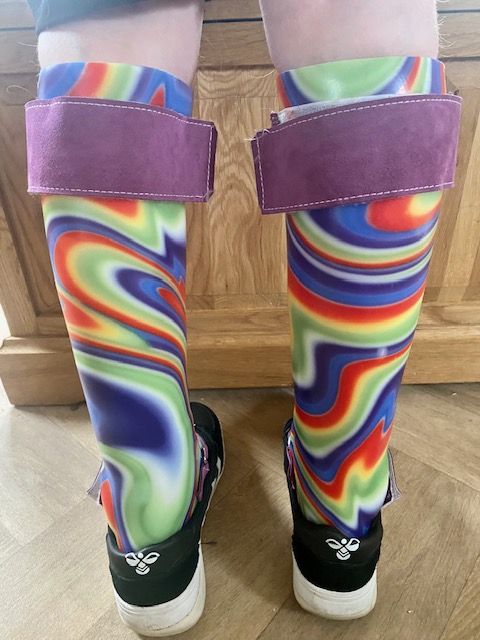 Tie dye multi-coloured ankle foot orthoses, or splints, for a Cerebral Palsy patient