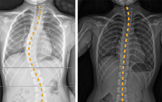 Juvenile scoliosis case study of three-year-old London Orthotic Consultancy patient