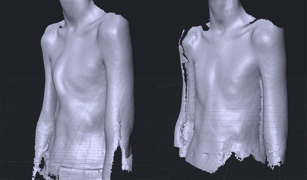 Pectus carinatum bracing scans before and after treatment