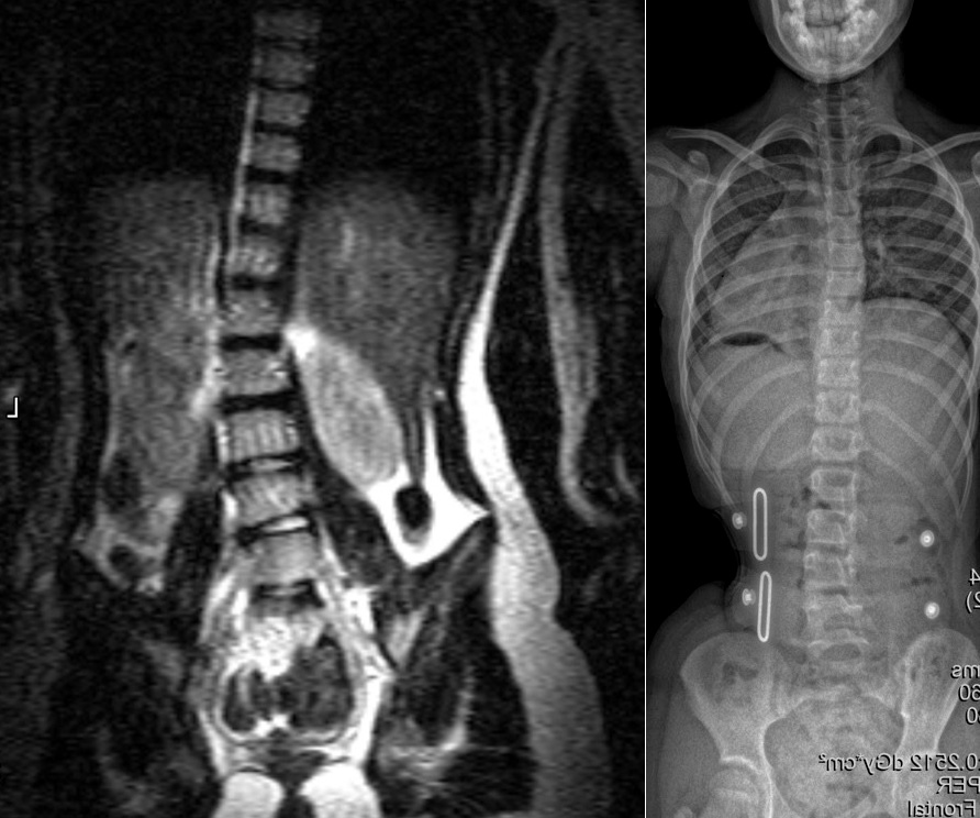 Before and after scans of nine-year-old scoliosis patient's back before and after bracing treatment with the LOC Scoliosis Brace