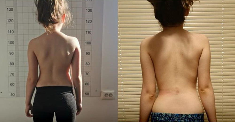 Iulia's mum first noticed her scoliosis when she always leaned to one side and her body appeared tilted.
